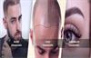 Beste Haartransplantatie Nederland