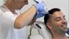 Haartransplantatie