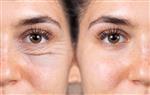 Facts You Must Know about Blepharoplasty