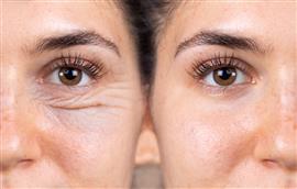 Facts You Must Know about Blepharoplasty