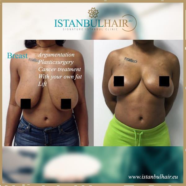 Grote foto borstvergroting bij istanbulhair.eu erotiek tepelzuigers