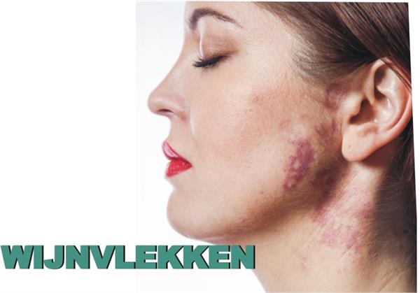 Grote foto laser ontharen hele lichaam 229 beauty en gezondheid overige beauty en gezondheid